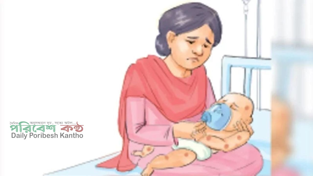 হামের উপসর্গে নিহত ১২০০ ছাড়াল
